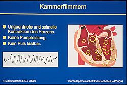 Kammerflimmern